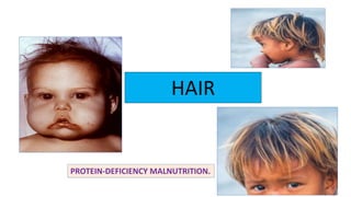 PROTEIN-DEFICIENCY MALNUTRITION.
HAIR
 