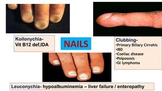 NAILS
Koilonychia-
Vit B12 def,IDA
Clubbing-
•Primary Biliary Cirrohis
•IBD
•Coeliac disease
•Polpososis
•GI lymphoma
Leuconychia- hypoalbuminemia – liver failure / enteropathy
 
