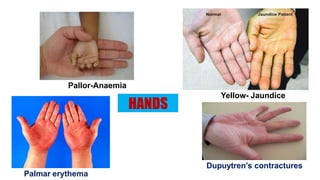 HANDS
Palmar erythema
Dupuytren’s contractures
Pallor-Anaemia
Yellow- Jaundice
 