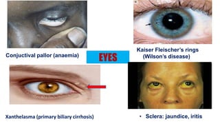 Xanthelasma (primary biliary cirrhosis)
EYESConjuctival pallor (anaemia)
• Sclera: jaundice, iritis
Kaiser Fleischer’s rings
(Wilson’s disease)
 