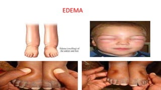 EDEMA
 