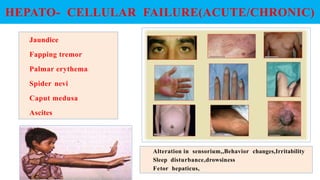 Jaundice
Fapping tremor
Palmar erythema
Spider nevi
Caput medusa
Ascites
HEPATO- CELLULAR FAILURE(ACUTE/CHRONIC)
Alteration in sensorium,,Behavior changes,Irritability
Sleep disturbance,drowsiness
Fetor hepaticus,
 