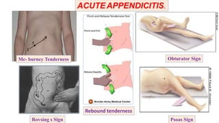 ACUTEAPPENDICITIS.
Mc- burney Tenderness
Rovsing s Sign
Obturator Sign
Psoas Sign
Rebound tenderness
 