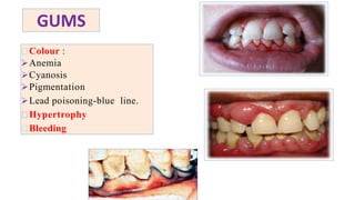 GUMS
Colour :
Anemia
Cyanosis
Pigmentation
Lead poisoning-blue line.
Hypertrophy
Bleeding
 