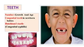 TEETH
Number -Growth And Age
Congenital teeth in newborn
babies
Hutchison’s teeth-
(Congenital syphilis)
 