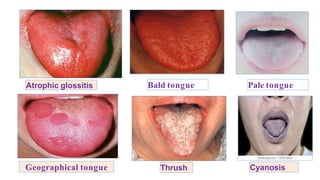 Atrophic glossitis
ThrushGeographical tongue
Bald tongue Pale tongue
Cyanosis
 