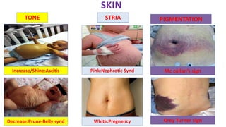 SKIN
TONE
Increase/Shine:Ascitis
Decrease:Prune-Belly synd
STRIA
Pink:Nephrotic Synd
White:Pregnency
PIGMENTATIONSTRIA
Mc cullan’s sign
Grey Turner sign
 