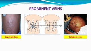 PROMINENT VEINS
Caput Meduce Collateral veins
Umbilicus(Inverted/Flat/Everted/Smiling )
 