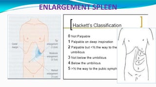 ENLARGEMENT SPLEEN
 