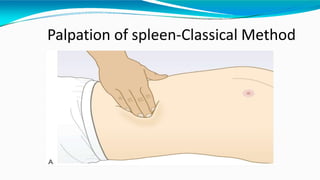 Palpation of spleen-Classical Method
 