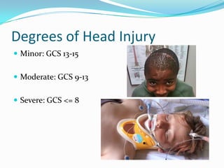 Degrees of Head Injury
 Minor: GCS 13-15
 Moderate: GCS 9-13
 Severe: GCS <= 8
 