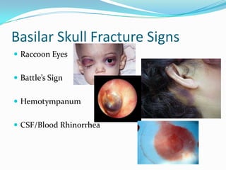 Basilar Skull Fracture Signs
 Raccoon Eyes
 Battle’s Sign
 Hemotympanum
 CSF/Blood Rhinorrhea
 