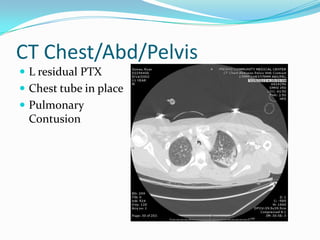 CT Chest/Abd/Pelvis
 L residual PTX
 Chest tube in place
 Pulmonary
Contusion
 