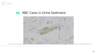 Pediatric Hematuria Case Presentation PPTX | PPTX