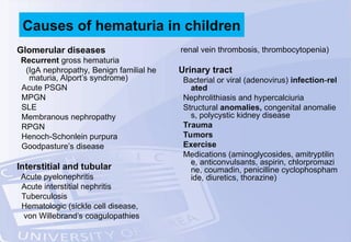 Glomerular diseases
Recurrent gross hematuria
(IgA nephropathy, Benign familial he
maturia, Alport’s syndrome)
Acute PSGN
MPGN
SLE
Membranous nephropathy
RPGN
Henoch-Schonlein purpura
Goodpasture’s disease
Interstitial and tubular
Acute pyelonephritis
Acute interstitial nephritis
Tuberculosis
Hematologic (sickle cell disease,
von Willebrand’s coagulopathies
renal vein thrombosis, thrombocytopenia)
Urinary tract
Bacterial or viral (adenovirus) infection-rel
ated
Nephrolithiasis and hypercalciuria
Structural anomalies, congenital anomalie
s, polycystic kidney disease
Trauma
Tumors
Exercise
Medications (aminoglycosides, amitryptilin
e, anticonvulsants, aspirin, chlorpromazi
ne, coumadin, penicilline cyclophospham
ide, diuretics, thorazine)
Causes of hematuria in children
 