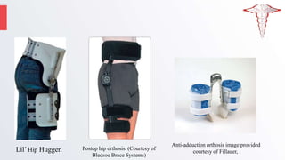 Anti-adduction orthosis image provided
courtesy of Fillauer,
Postop hip orthosis. (Courtesy of
Bledsoe Brace Systems)
Lil’ Hip Hugger.
 