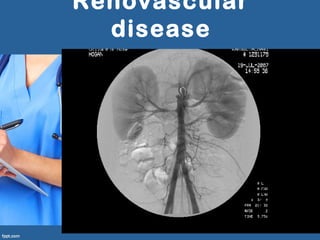 Renovascular
disease
 