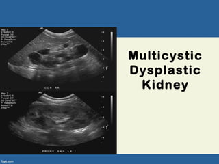 Multicystic
Dysplastic
Kidney
 