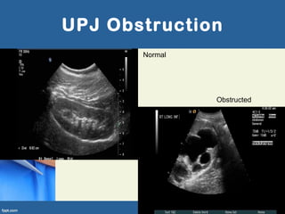 UPJ Obstruction
Normal
Obstructed
 