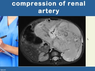 compression of renal
artery
L
 
