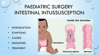 case of pediatric intestinal intussception.pptx