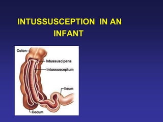 INTUSSUSCEPTION IN AN
INFANT
 