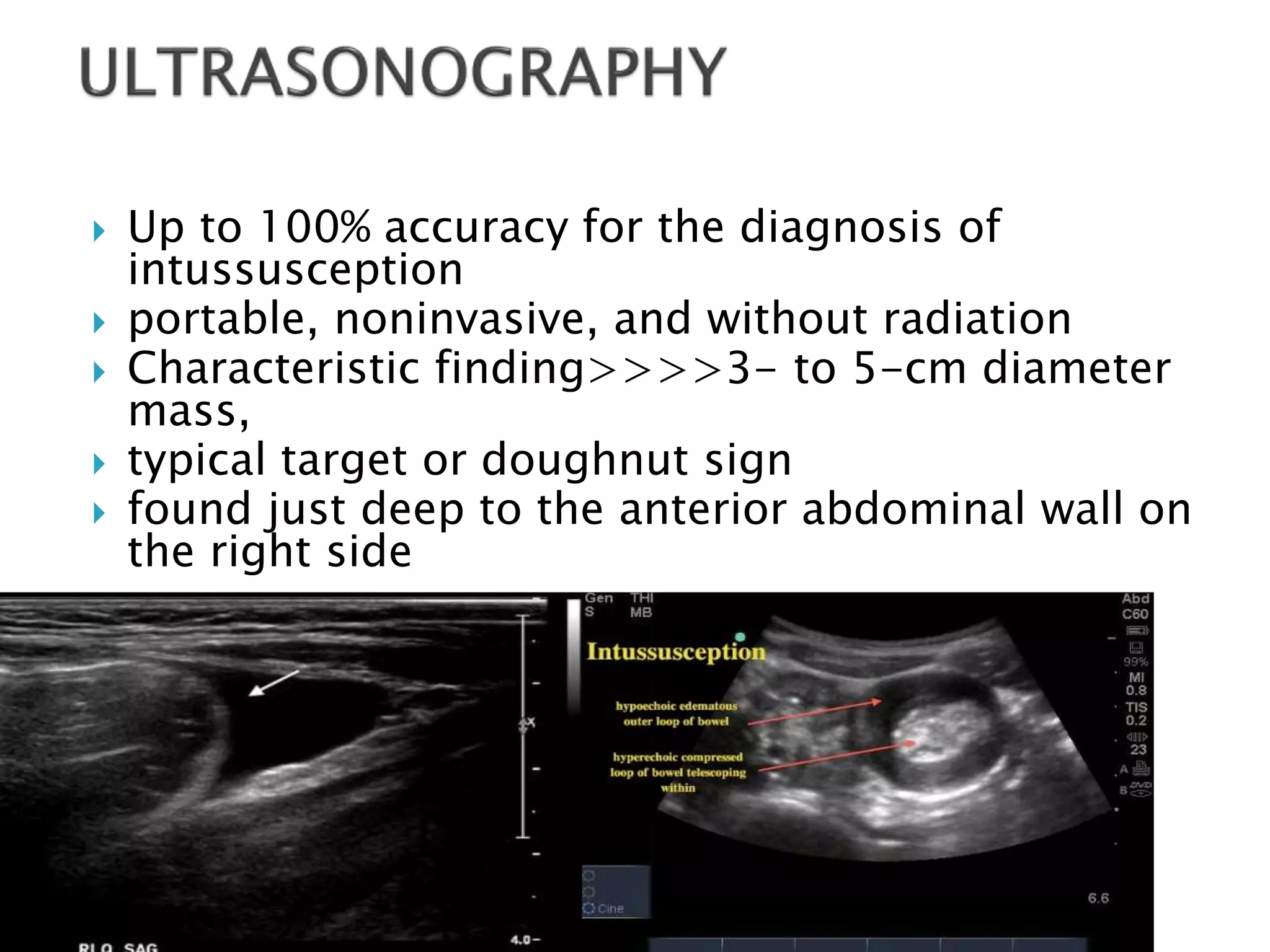 Up to 100% accuracy for the diagnosis of
intussusception
 portable, noninvasive, and without radiation
 Characteristic finding>>>>3- to 5-cm diameter
mass,
 typical target or doughnut sign
 found just deep to the anterior abdominal wall on
the right side
 