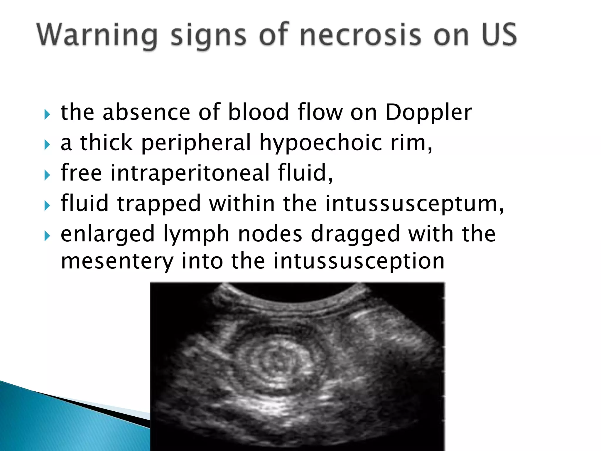  the absence of blood flow on Doppler
 a thick peripheral hypoechoic rim,
 free intraperitoneal fluid,
 fluid trapped within the intussusceptum,
 enlarged lymph nodes dragged with the
mesentery into the intussusception
 