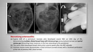 Necrotizing enterocolitis
(a) Supine AXR of a premature neonate who developed severe NEC on 14th day of life,
demonstrating multiple dilated bowel loop with intramural gas (pneumatosis) (arrow) and portal
venous gas (branching linear lucencies in the liver extending to the periphery).
(b) The same infant developed bowel obstruction several weeks after the NEC episode.
(c) Contrast enema study demonstrates a focal stricture (curved arrow) with a localized perforation
at the site of previous NEC (short arrow). 103
 