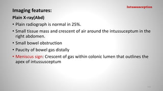 Imaging features:
Plain X-ray(Abd)
• Plain radiograph is normal in 25%.
• Small tissue mass and crescent of air around the intussuceptum in the
right abdomen.
• Small bowel obstruction
• Paucity of bowel gas distally
• Meniscus sign: Crescent of gas within colonic lumen that outlines the
apex of intussusceptum
113
Intussusception
 