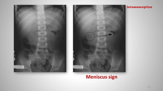 Meniscus sign
115
Intussusception
 