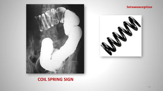 COIL SPRING SIGN
118
Intussusception
 