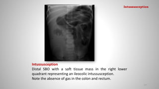 Intussusception
Distal SBO with a soft tissue mass in the right lower
quadrant representing an ileocolic intussusception.
Note the absence of gas in the colon and rectum.
127
Intussusception
 