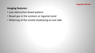 Imaging features:
• Low obstructive bowel pattern
• Bowel gas in the scrotum or inguinal canal
• Widening of the scrotal shadowing on one side
131
Inguinal Hernia
 