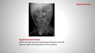 Inguinoscrotal hernia
AXR of neonate demonstrating loops of bowel in the left
inguinal region extending down to the scrotum.
132
Inguinal Hernia
 