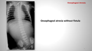 Oesophageal atresia without fistula
15
Oesophageal Atresia
 