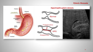 17
Pyloric Stenosis
 