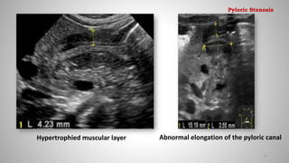 Hypertrophied muscular layer Abnormal elongation of the pyloric canal
23
Pyloric Stenosis
 