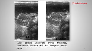 Axial oblique ultrasound shows thickened,
hypoechoic muscular wall and elongated pyloric
canal 25
Pyloric Stenosis
 
