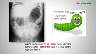 Supine radiograph in an infant with vomiting
demonstrates caterpillar sign of active gastric
hyperperistalsis.
28
Pyloric Stenosis
 