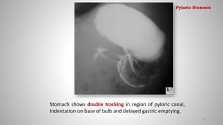 Stomach shows double tracking in region of pyloric canal,
indentation on base of bulb and delayed gastric emptying.
29
Pyloric Stenosis
 