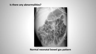 Normal neonatal bowel gas pattern
Is there any abnormalities?
3
 