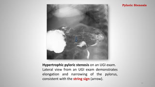 Hypertrophic pyloric stenosis on an UGI exam.
Lateral view from an UGI exam demonstrates
elongation and narrowing of the pylorus,
consistent with the string sign (arrow).
31
Pyloric Stenosis
 