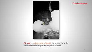 Tit sign - outpouching contrast on lesser curve by
distorted muscle in hypertrophic pyloric stenosis.
32
Pyloric Stenosis
 