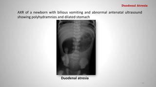 Duodenal atresia
AXR of a newborn with bilious vomiting and abnormal antenatal ultrasound
showing polyhydramnios and dilated stomach
41
Duodenal Atresia
 
