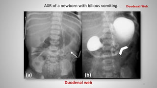 Duodenal web
AXR of a newborn with bilious vomiting.
44
Duodenal Web
 
