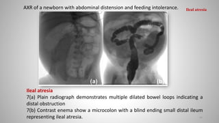 Ileal atresia
7(a) Plain radiograph demonstrates multiple dilated bowel loops indicating a
distal obstruction
7(b) Contrast enema show a microcolon with a blind ending small distal ileum
representing ileal atresia.
AXR of a newborn with abdominal distension and feeding intolerance.
63
Ileal atresia
 