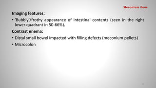 Imaging features:
• 'Bubbly'/frothy appearance of intestinal contents (seen in the right
lower quadrant in 50-66%).
Contrast enema:
• Distal small bowel impacted with filling defects (meconium pellets)
• Microcolon
69
Meconium ileus
 