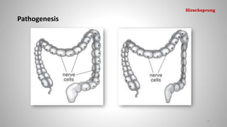 Pathogenesis
74
Hirschsprung
 