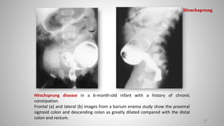 Hirschsprung disease in a 6-month-old infant with a history of chronic
constipation.
Frontal (a) and lateral (b) images from a barium enema study show the proximal
sigmoid colon and descending colon as greatly dilated compared with the distal
colon and rectum. 88
Hirschsprung
 